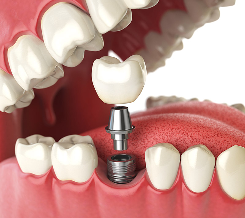 dental implants at Centre & 12 dental