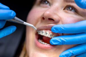a lady is having orthodontic treatment