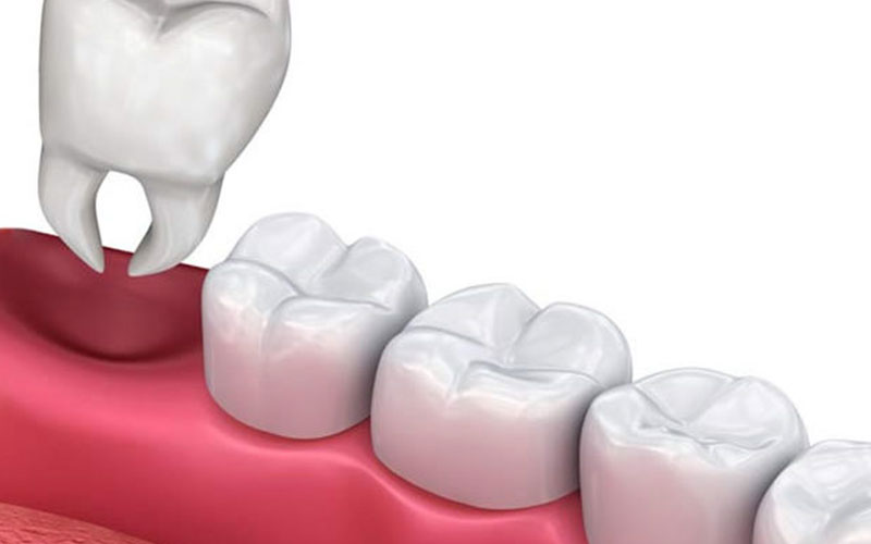 Wisdom tooth Extraction in Calgary